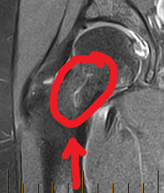 MRI image of the stress fracture in my hip. The cause of me going stir crazy.